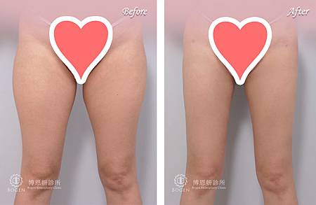 大腿抽脂,大腿抽脂案例,抽脂手術,李岳樺醫師,博恩妍